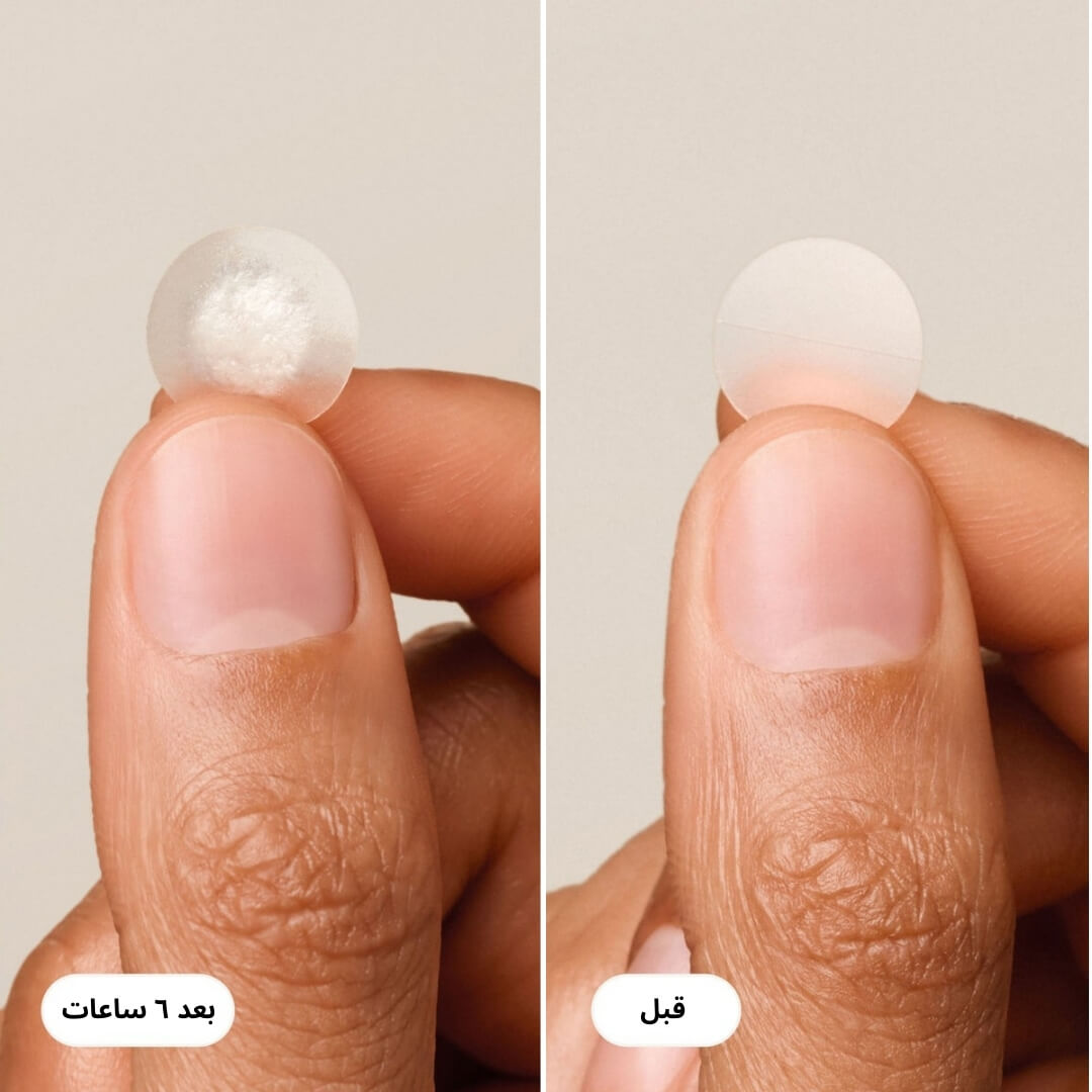 لاصقات حبوب Undo الأصلية