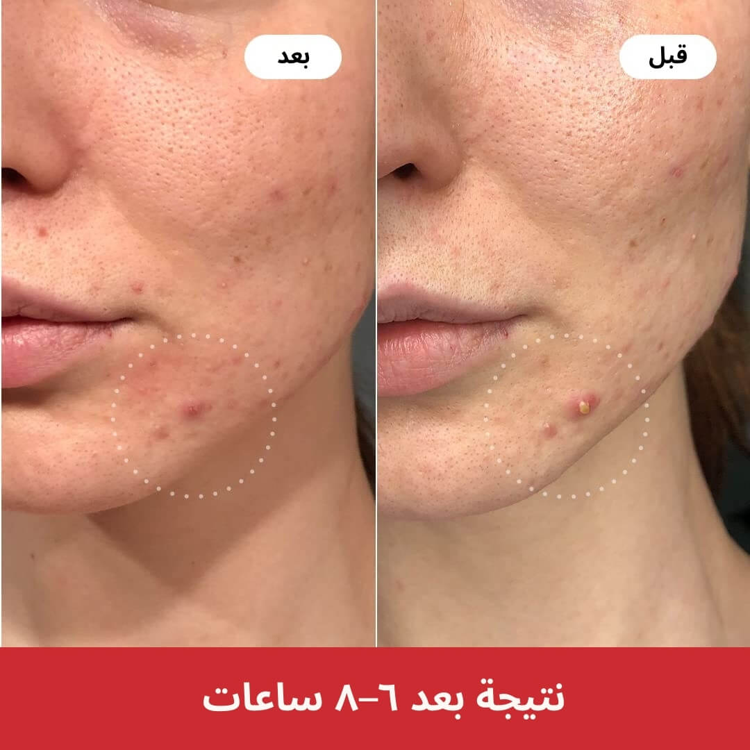 لاصقات حبوب Undo الأصلية